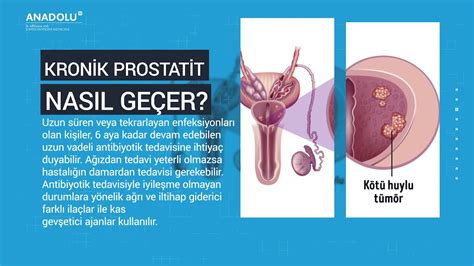 prostat iltihabı tedavisi bitkisel